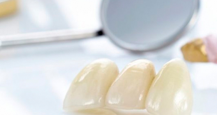 Скидки в стоматологической клинике на керамические коронки виниры